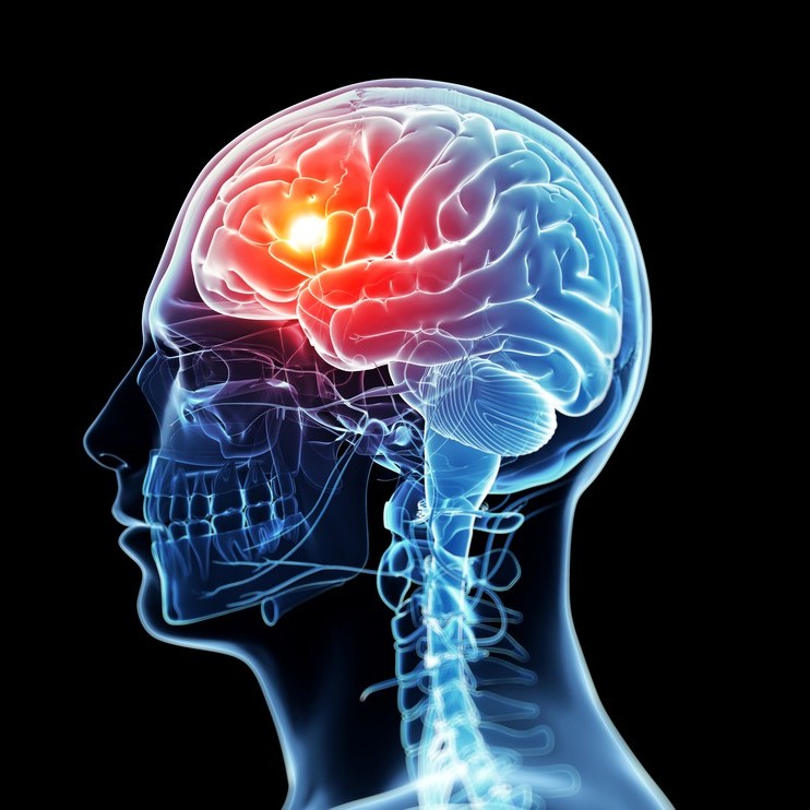 Newport Beach Nerve Decompression Surgery | Orange County Migraine Headache